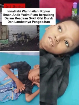 Viral! Kisah Pilu di Dumai; Bocah Yatim Piatu Korban Gizi Buruk Tewas